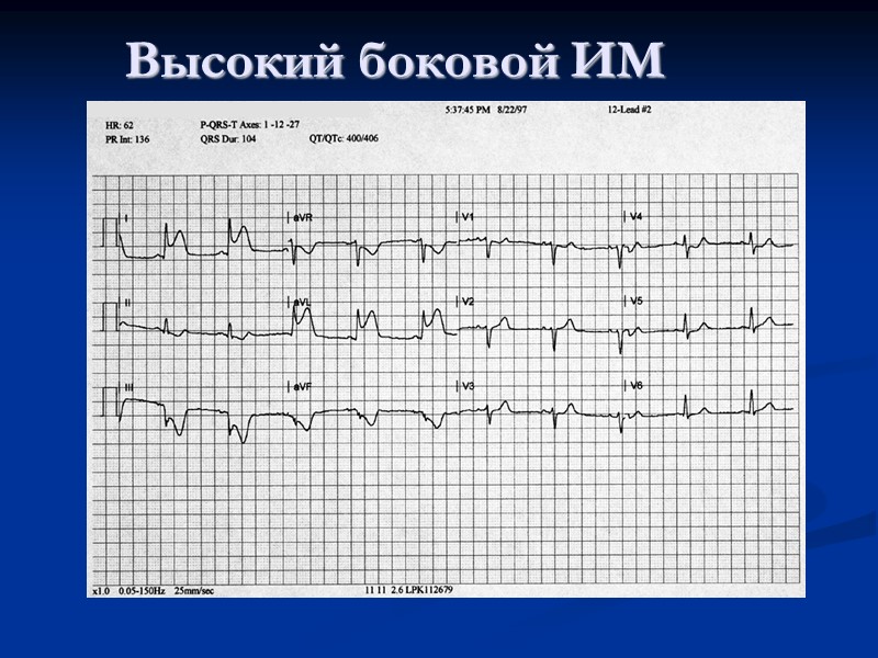 Высокий боковой ИМ